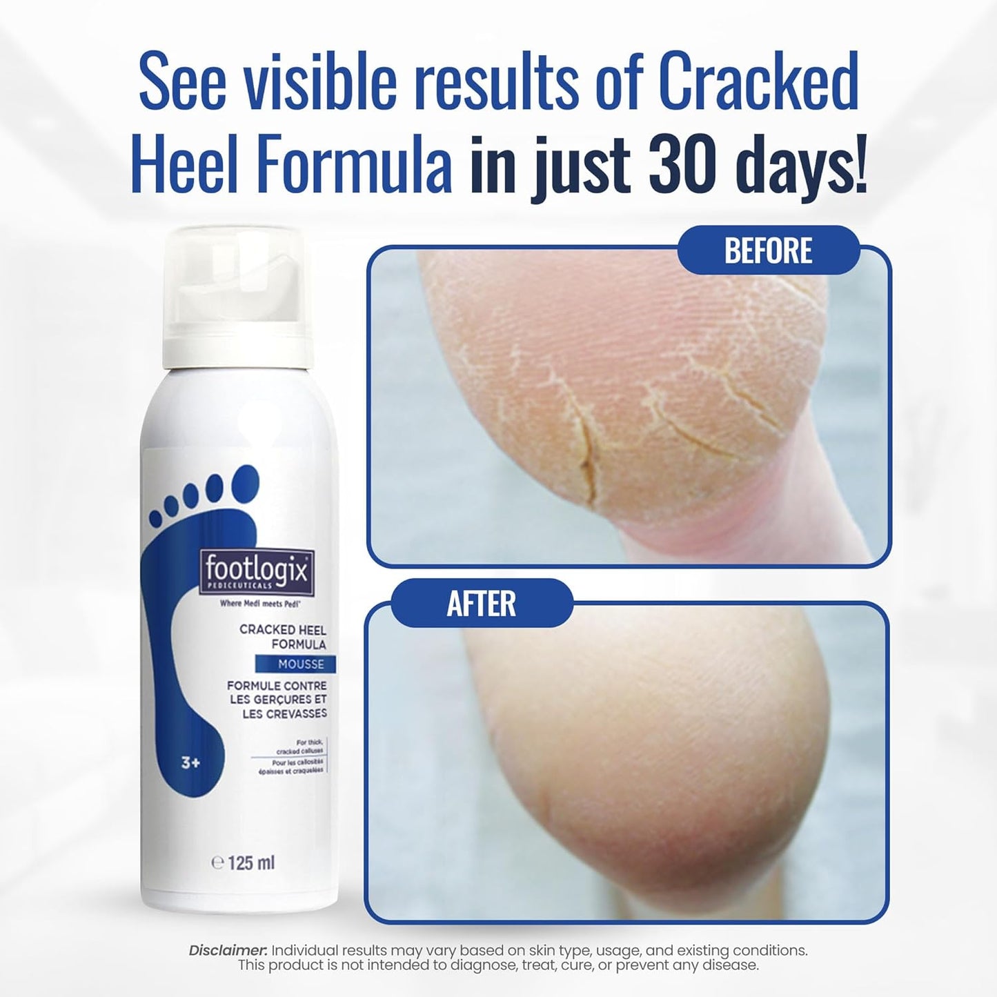 Footlogix - Cracked Heel Formula - 4.23oz / 125ml [Beauty]